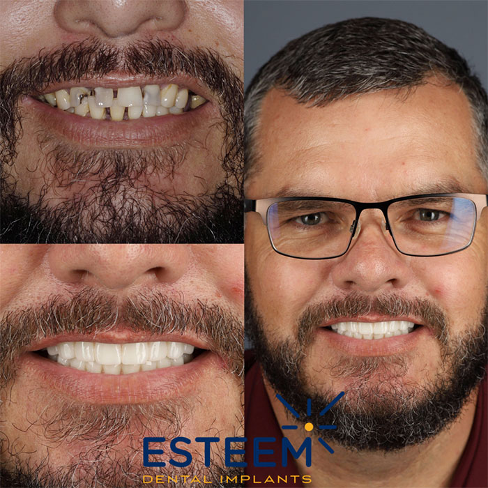 esteem before and after case