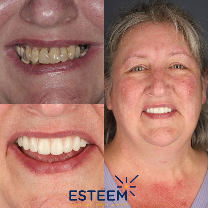 esteem before and after case